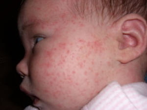 Проявление аллергии на коже