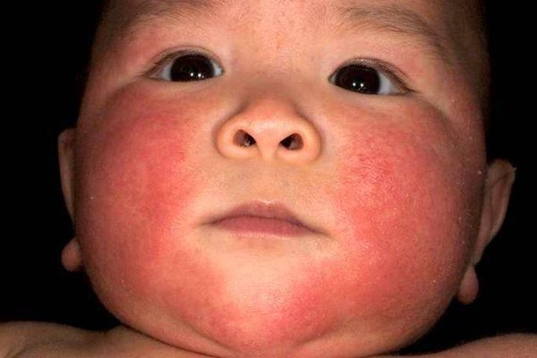 Аллергический дерматит на лице у младенца