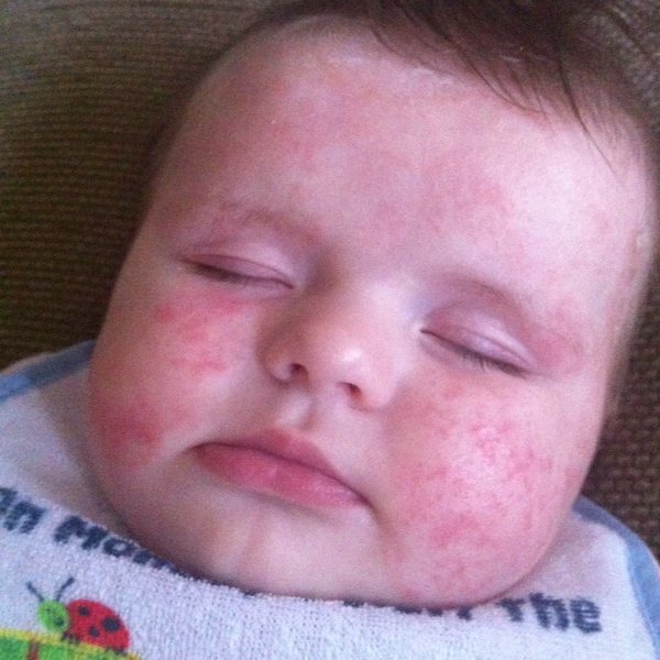 Одной из самых главных причин возникновения аллергии является простое перекармливание малыша