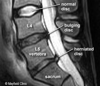 MRI herniated disc