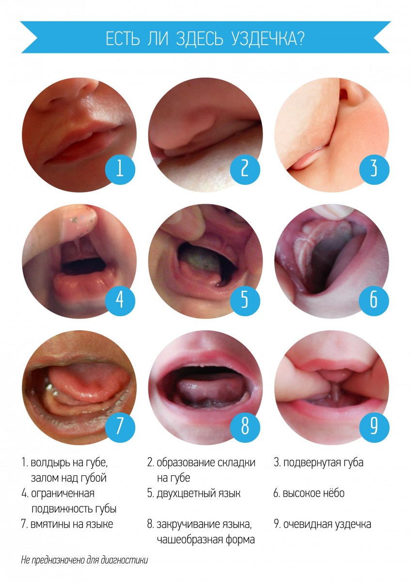 Уздечка во рту у новорожденного Короткая уздечка у новорожденного — как определить и что делать 1365