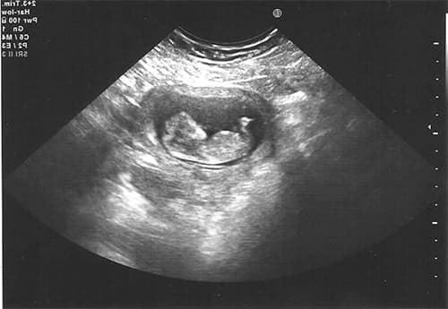 узи беременности на ранних сроках фото
