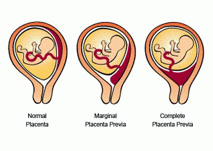 низкая плацентация при беременности 20 недель причины