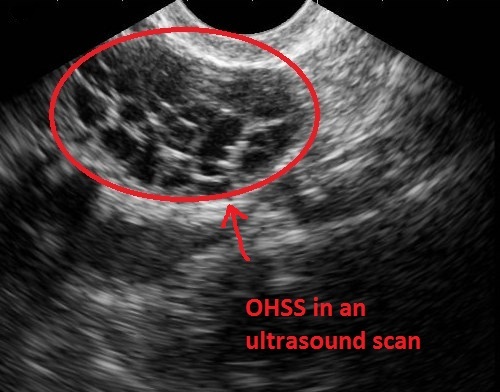 over hyper stimulation syndrome - OHSS image on ultrasound scan