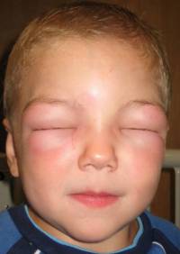 Аллергический отек лица у ребенка