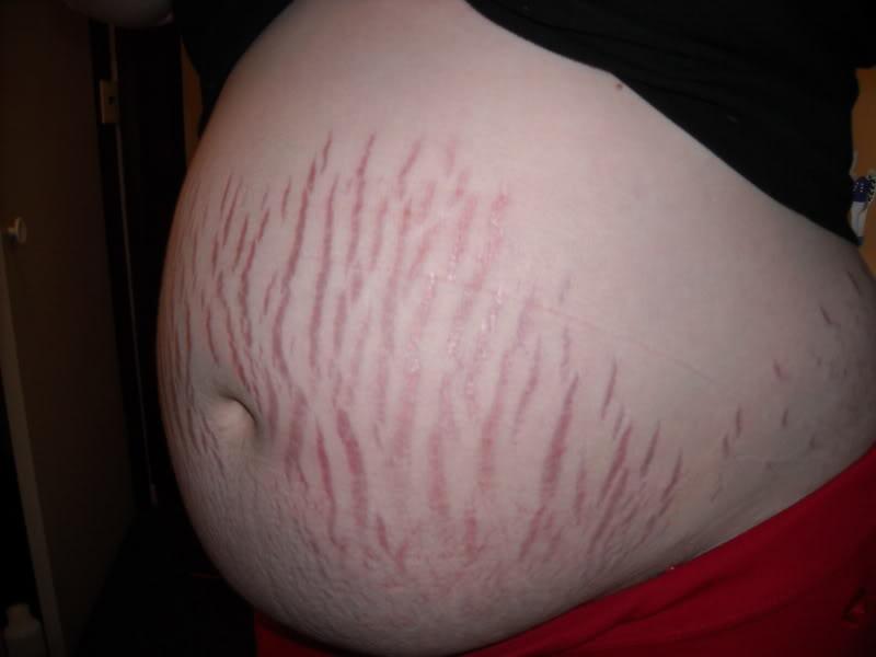 Image result for stretch marks pregnancy