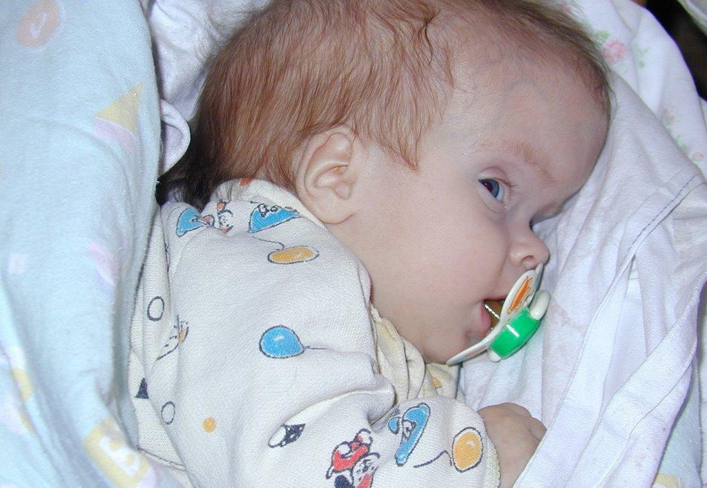 Голова младенца при поражении гидроцефалией