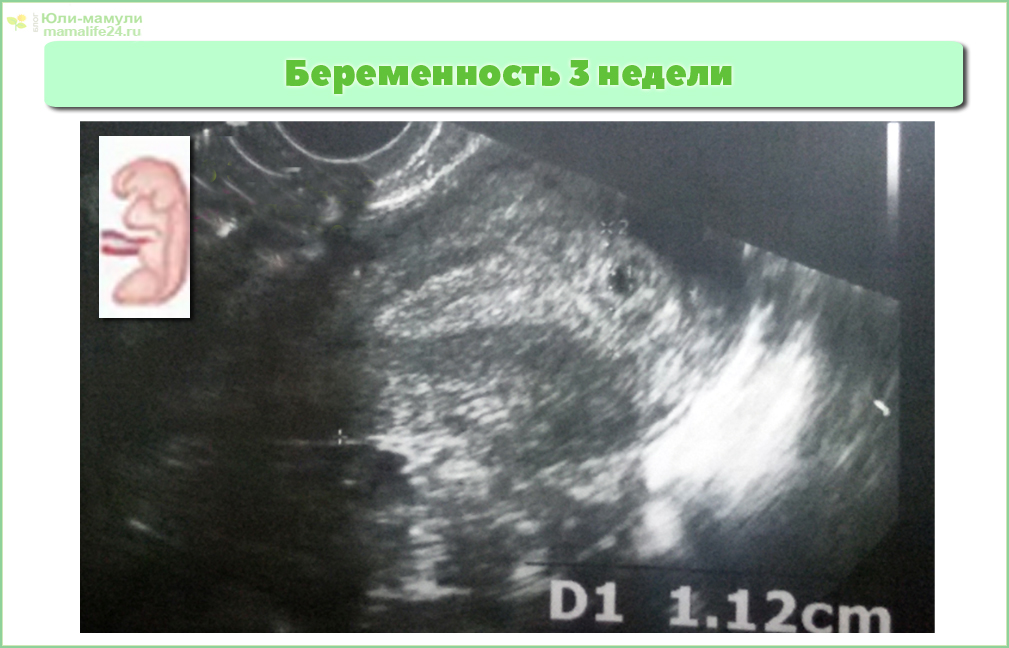 беременность 3 недели фото плода