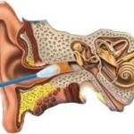 Как происходит чистка ушей