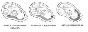 Чем горозит низкая плацентация