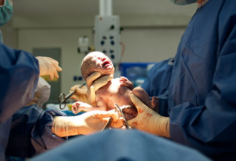 Появление ребенка путем операции